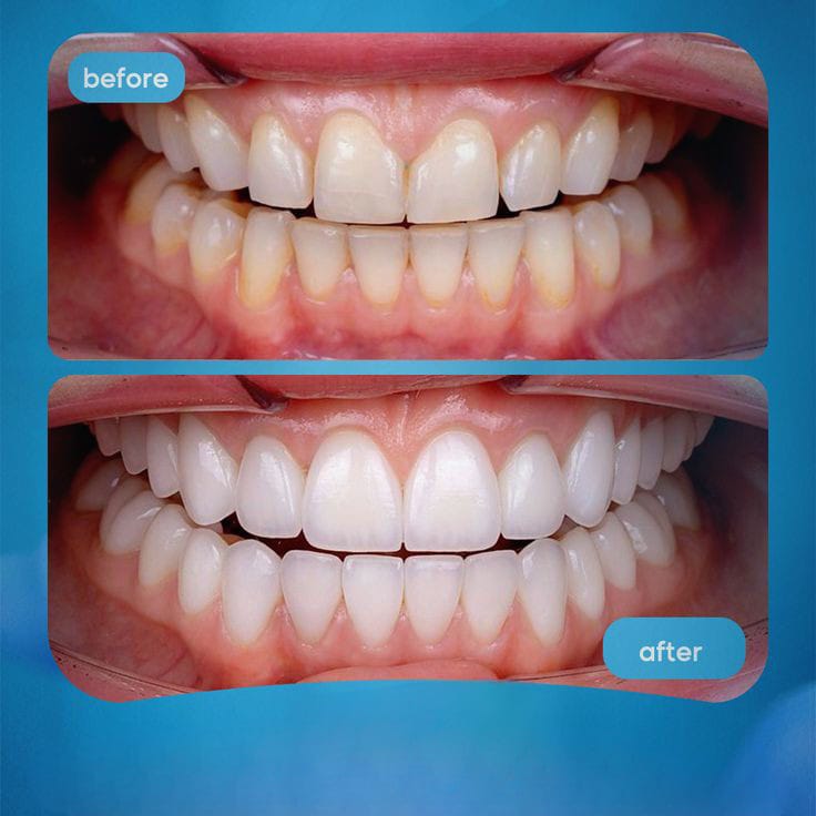 Teeth Cleaning & Whitening